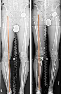 High Tibial Osteotomy